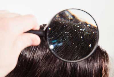 头屑过多用什么洗发水效果好，中医用中药根治头皮屑的方法